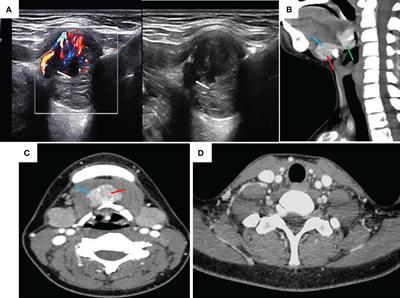 Diagnosis and treatment of ectopic thyroid carcinoma: A case report and literature review